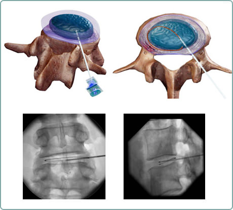Um catéter eletrotérmico é inserido e posicionado através de uma agulha ao longo do disco intervertebral.