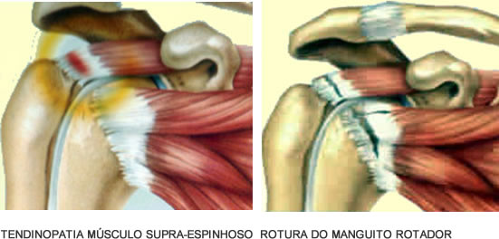 Tendinopatia