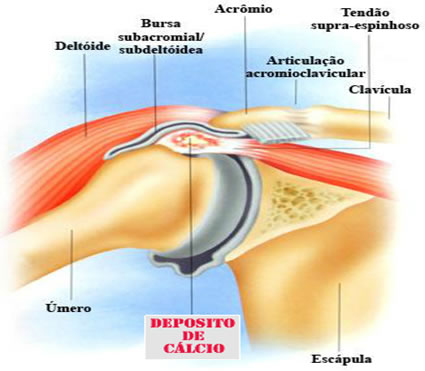 Tendinopatia calcárea