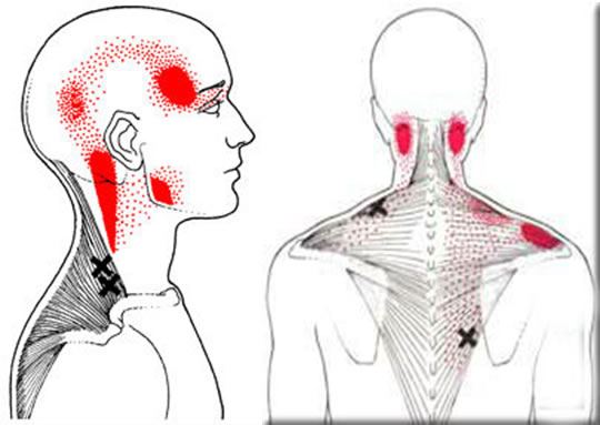 Dor miofascial – músculo trapézio
