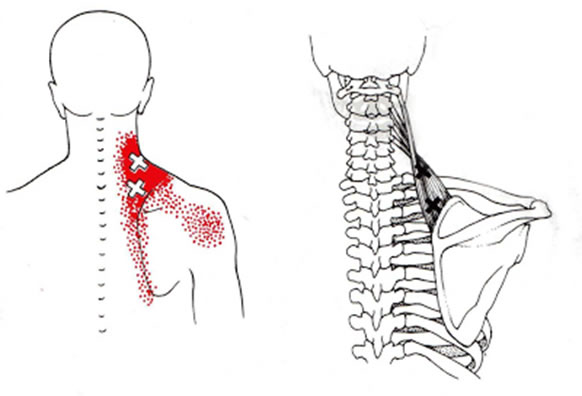 Dor miofascial - músculo levantador da escápula