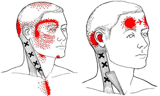 Dor miofascial – músculo esternocleidomastóideo