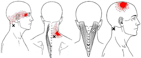 Dor miofascial – músculo esplênios da cabeça e cervical