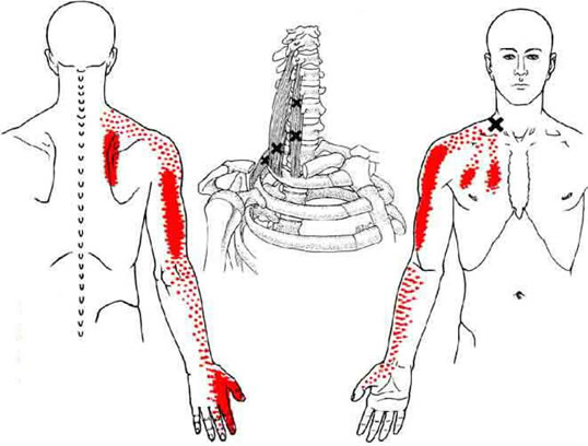 Dor miofascial – músculo escalenos