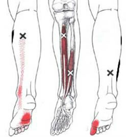 Dor miofascial – músculo flexor longo dos dedos e músculo flexor longo do hálux