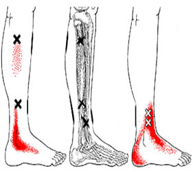 Dor miofascial – músculo fibular longo, músculo fibular curto e músculo fibular terceiro