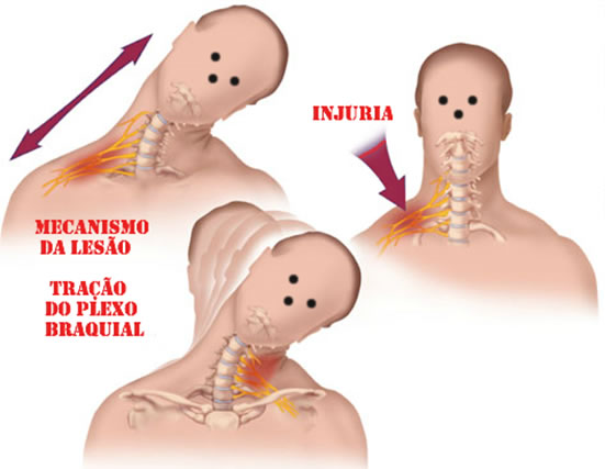 Lesão do plexo braquial