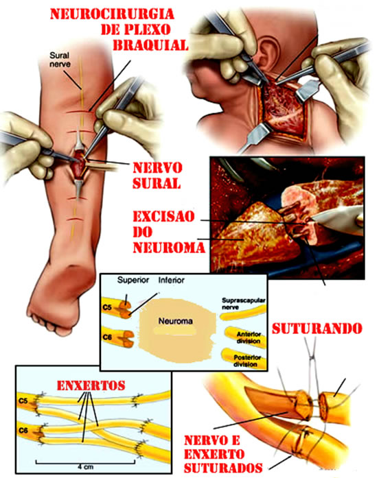 Cirurgia do plexo braquial